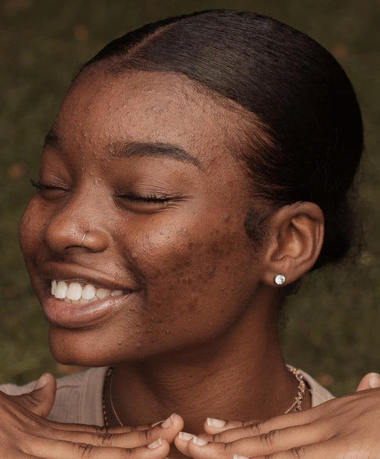 What's the Difference; Hyperpigmentation, Acne Scarring, Combination Skin
