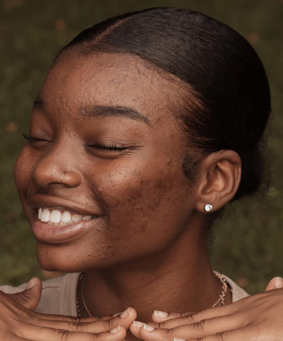 What's the Difference; Hyperpigmentation, Acne Scarring, Combination Skin